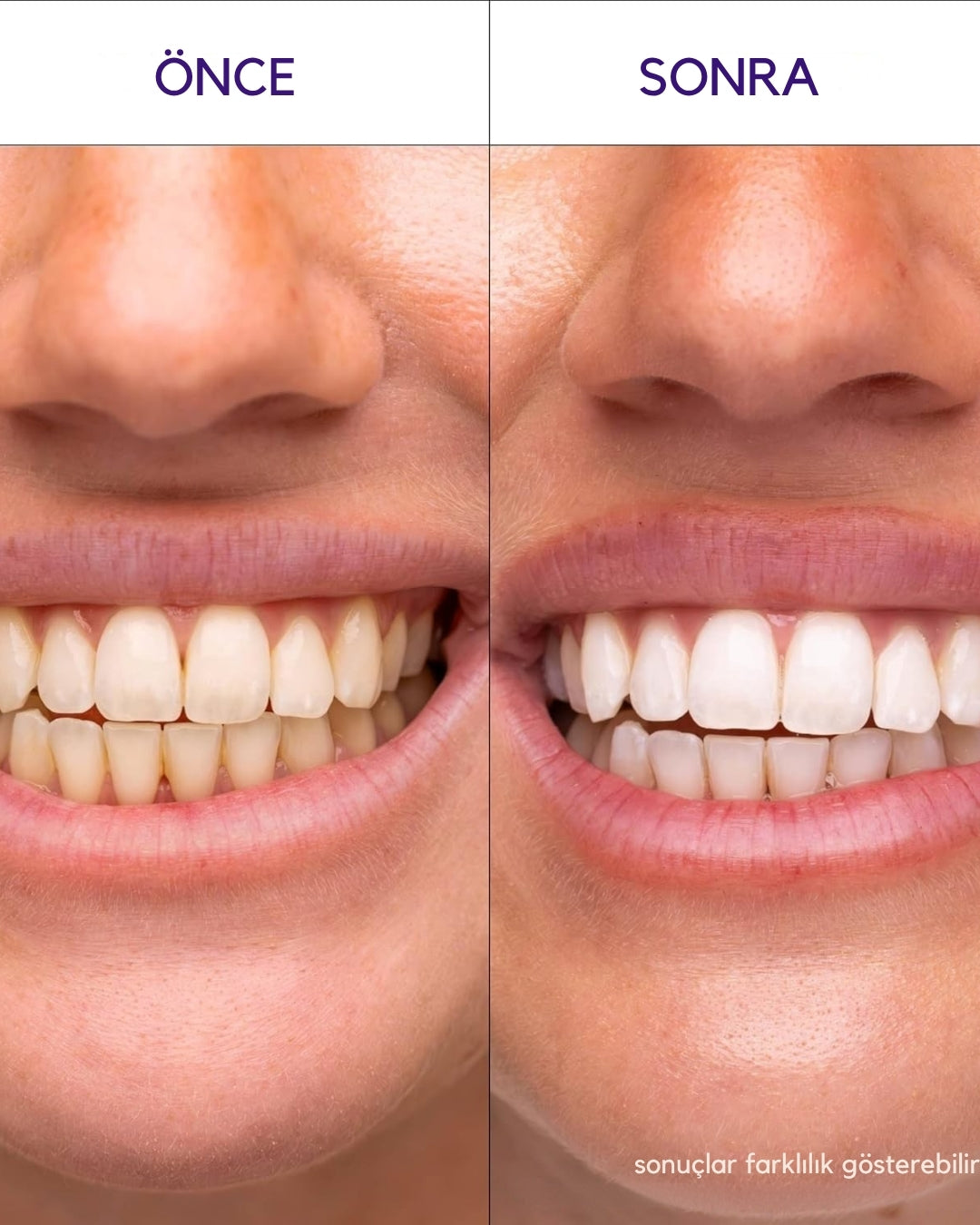 V34 SMILE™ Diş Beyazlatma Şeritleri
